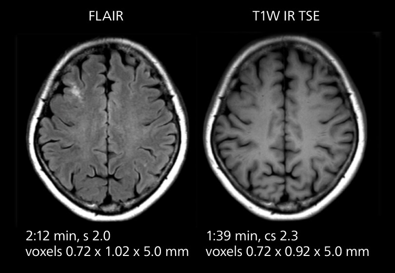 Brain mri one