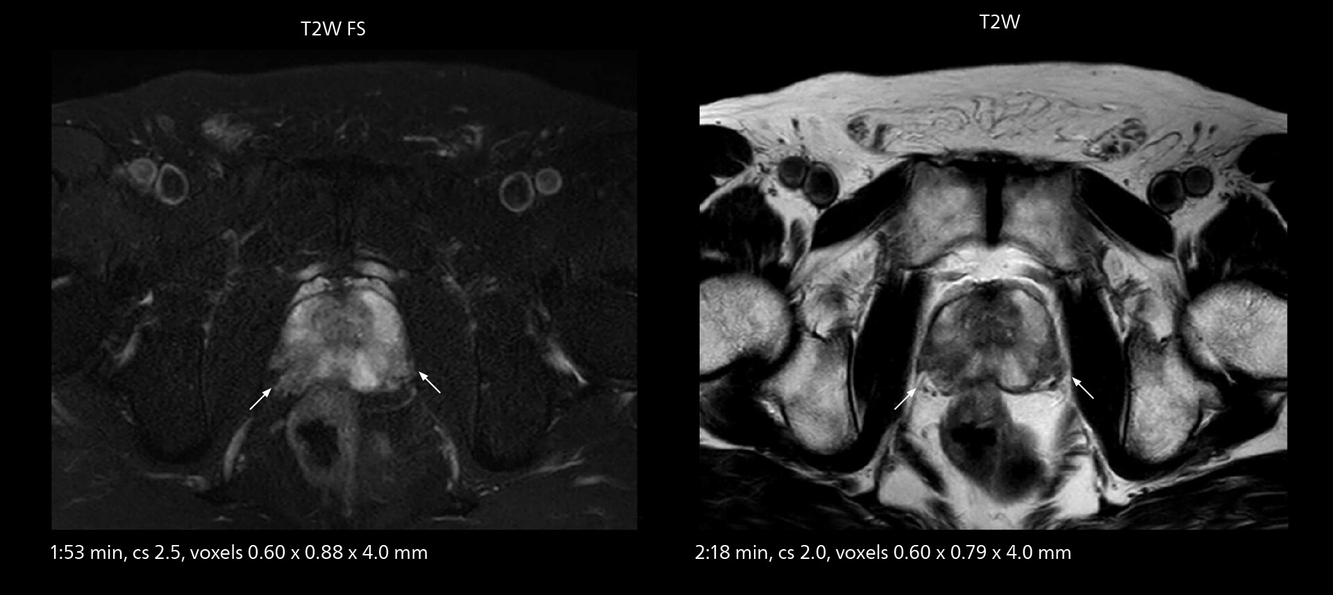 Prostate mri one