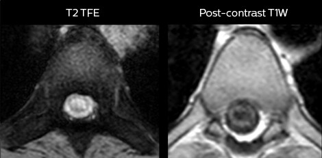 mri in ed myelopathy axial