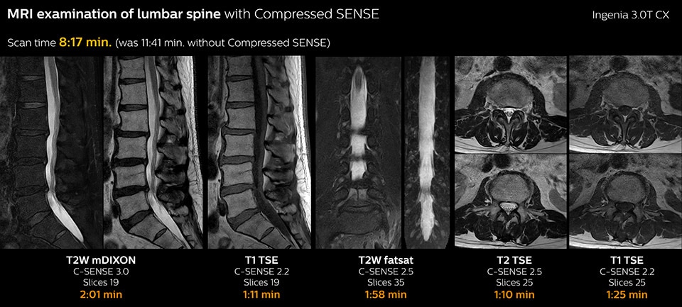 MRI examination of lumbar spine with Compressed SENSE