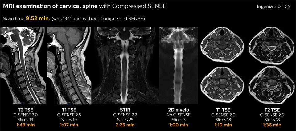 MRI examination of cervical spine with Compressed SENSE