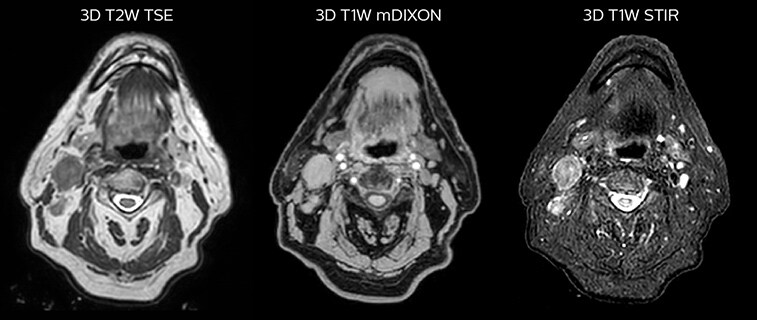 LaTour 3D Stir mDIXON MRI scans