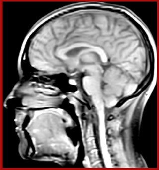 Myelin water imaging with Compressed SENSE