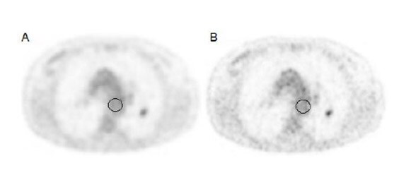 lung cancer image zwolle